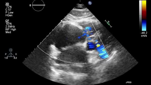 Ecografia Esame Transesofageo Del Cuore — Video Stock