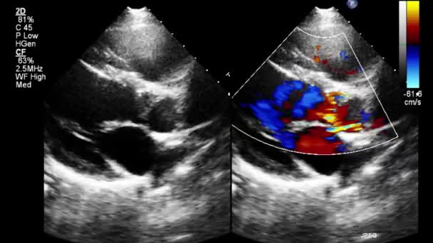 Echografie Transslokdarmonderzoek Van Het Hart — Stockvideo