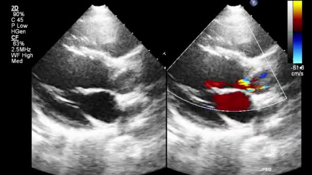 Ecografia Esame Transesofageo Del Cuore — Video Stock