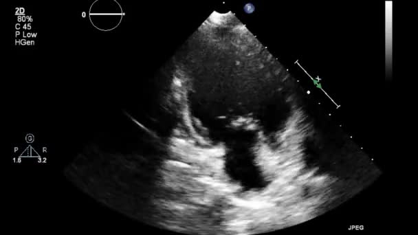 Ecografía Examen Transesofágico Del Corazón — Vídeo de stock