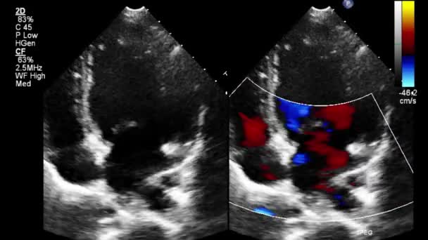 Echografie Transslokdarmonderzoek Van Het Hart — Stockvideo