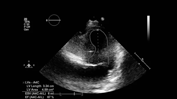 经食管超声下灰度型心脏影像学 — 图库照片