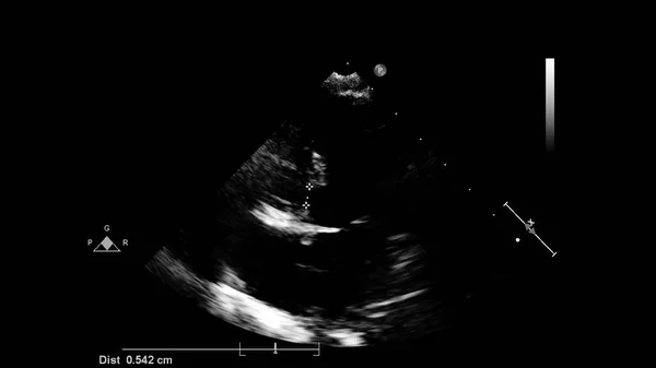 经食管超声下灰度型心脏影像学 — 图库照片