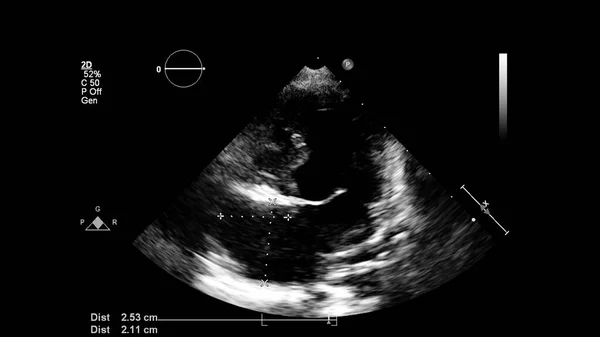 Transesofageal Ultrason Sırasında Kalbin Gri Ölçekli Görüntüsü — Stok fotoğraf