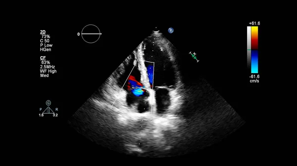 Imagem Coração Durante Ultrassom Transesofágico Com Modo Doppler — Fotografia de Stock