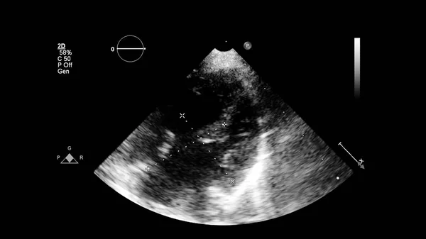 Изображение Сердца Сером Режиме Время Трансофагеального Ультразвука — стоковое фото