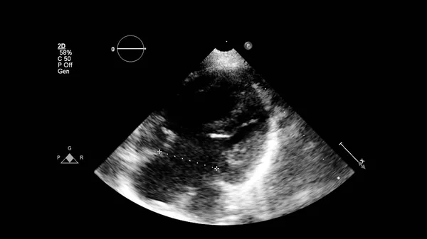 経食道超音波検査時のグレースケールモードで心臓の画像 — ストック写真