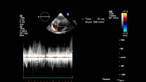 Immagine Del Cuore Durante Ecografia Transesofagea Con Modalità Doppler — Foto Stock