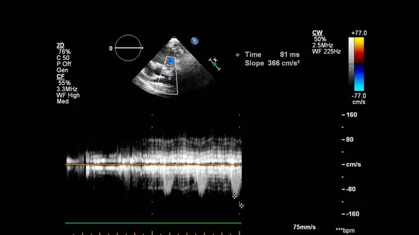 Transesofageal Ultrason Sırasında Doppler Kipi Ile Kalbin Görüntüsü — Stok fotoğraf