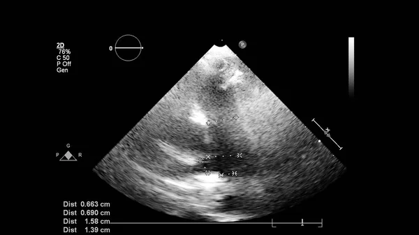 Transesofageal Ultrason Sırasında Kalbin Gri Ölçekli Görüntüsü — Stok fotoğraf