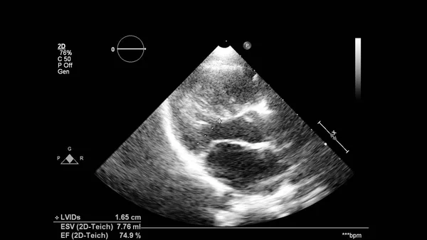 Afbeelding Van Het Hart Grijs Schaal Modus Tijdens Transesofageale Echografie — Stockfoto