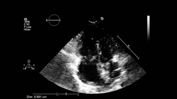 Transesofageal Ultrason Sırasında Kalbin Gri Ölçekli Görüntüsü — Stok fotoğraf