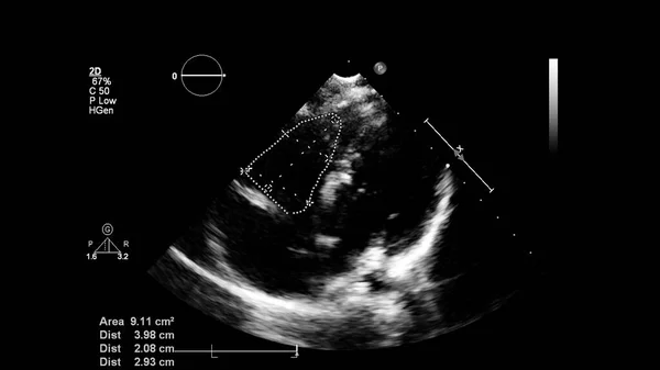 Transesofageal Ultrason Sırasında Kalbin Gri Ölçekli Görüntüsü — Stok fotoğraf