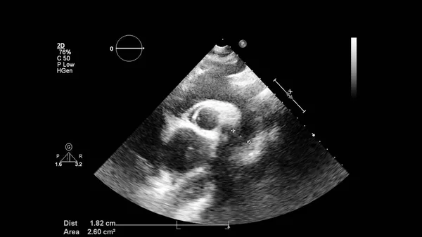 Imagem Coração Escala Cinza Durante Ultrassonografia Transesofágica — Fotografia de Stock