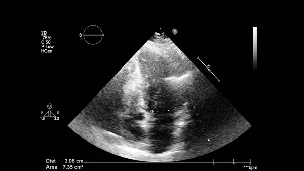 Image Cœur Mode Gris Lors Une Échographie Transœsophagienne — Photo