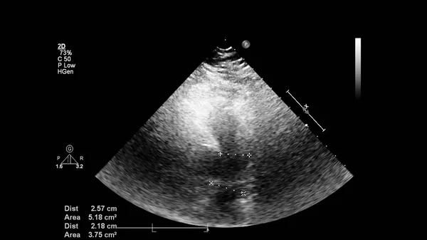 经食管超声下灰度型心脏影像学 — 图库照片