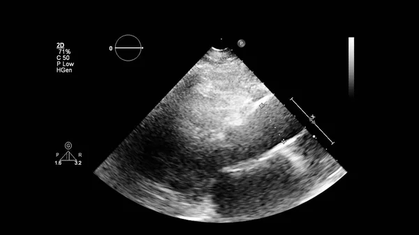 Bild Hjärtat Gråskala Transesofagalt Ultraljud — Stockfoto