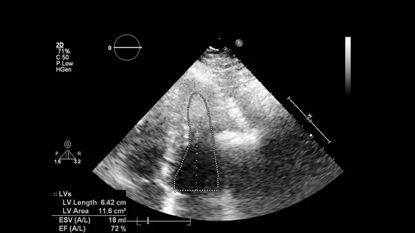 Bild Hjärtat Gråskala Transesofagalt Ultraljud — Stockfoto