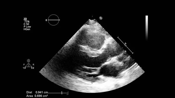 Afbeelding Van Het Hart Grijs Schaal Modus Tijdens Transesofageale Echografie — Stockfoto