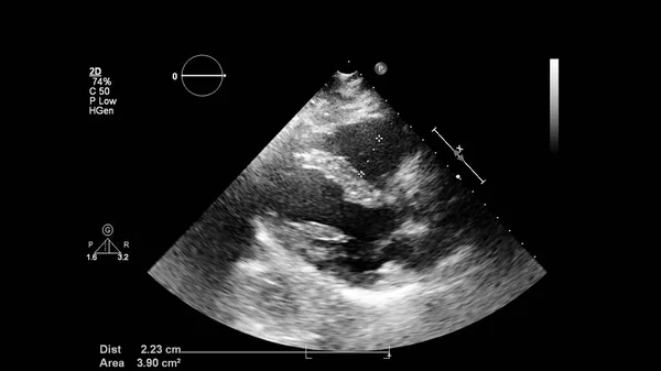 Afbeelding Van Het Hart Grijs Schaal Modus Tijdens Transesofageale Echografie — Stockfoto