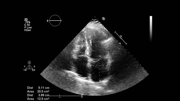 Afbeelding Van Het Hart Grijs Schaal Modus Tijdens Transesofageale Echografie — Stockfoto