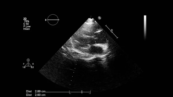 Image Cœur Mode Gris Lors Une Échographie Transœsophagienne — Photo