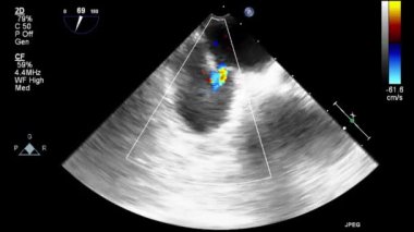 Kalbin ultrason transsofageal muayenesi.