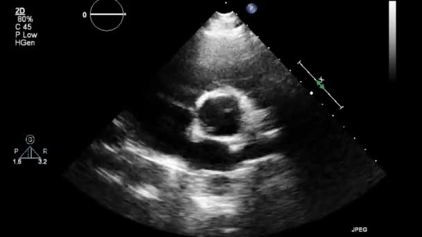 Ecografía Examen Transesofágico Del Corazón — Vídeos de Stock