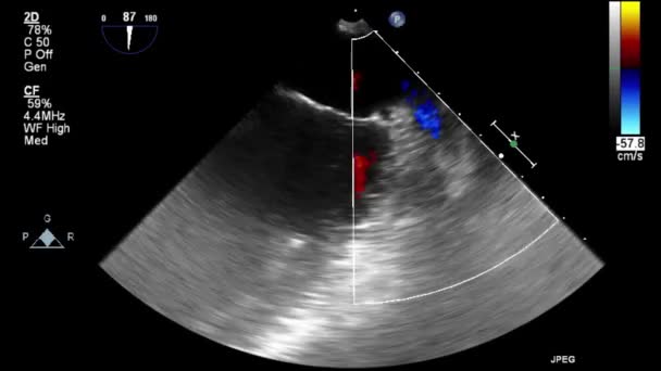 Ultrasound Transesophageal Examination Heart — Stock Video