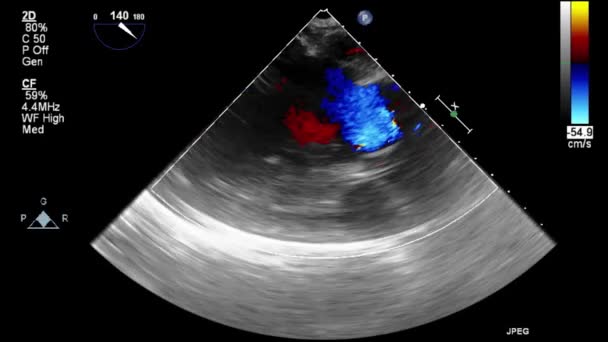 Ultrasound Transesophageal Examination Heart — Stock Video