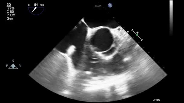 心臓の超音波経食道検査 — ストック動画