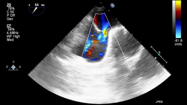 Ultrazvukové Transesofageální Vyšetření Srdce — Stock video