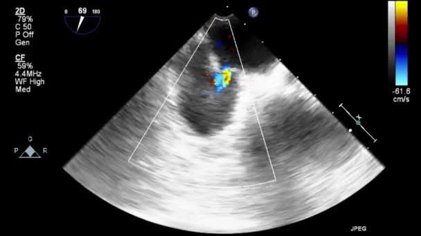 Ecografía Examen Transesofágico Del Corazón — Vídeos de Stock