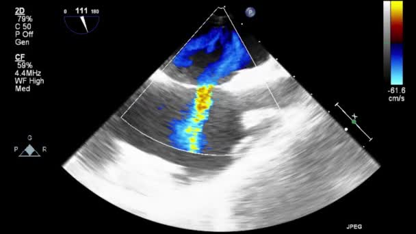 Ультразвуковое Трансофагеальное Исследование Сердца — стоковое видео
