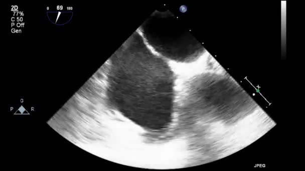 Ecografía Examen Transesofágico Del Corazón — Vídeo de stock