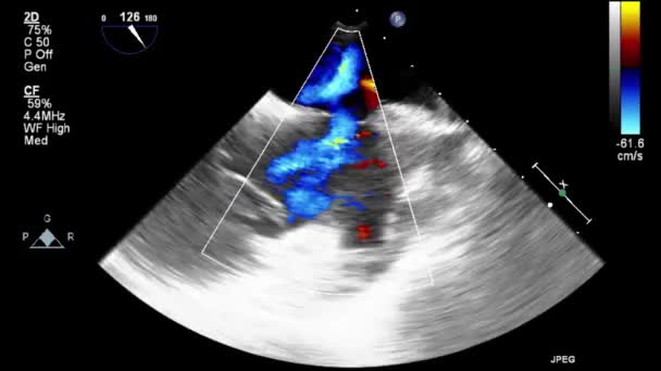 Exame Transesofágico Ultrassonográfico Coração — Vídeo de Stock