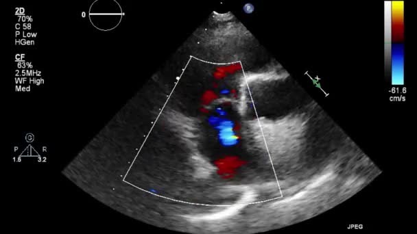 Examen Échographique Transœsophagien Cœur — Video