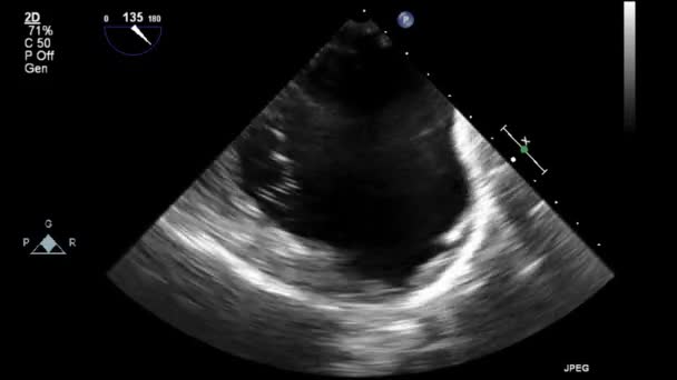 Ultraschall Transesophageale Untersuchung Des Herzens — Stockvideo