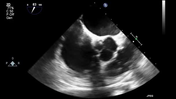 Ecografía Examen Transesofágico Del Corazón — Vídeo de stock