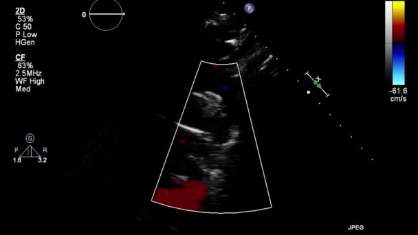 Echografie Transslokdarmonderzoek Van Het Hart — Stockvideo