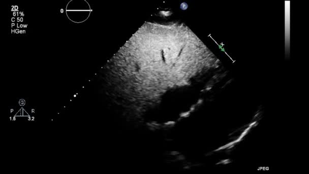 Ultrasound Transesophageal Examination Heart — Stock Video