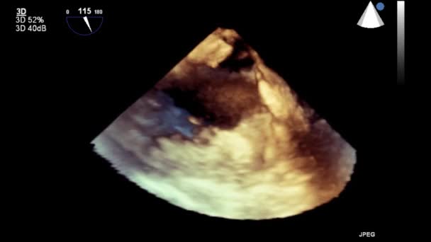 Echografie Transslokdarmonderzoek Van Het Hart — Stockvideo