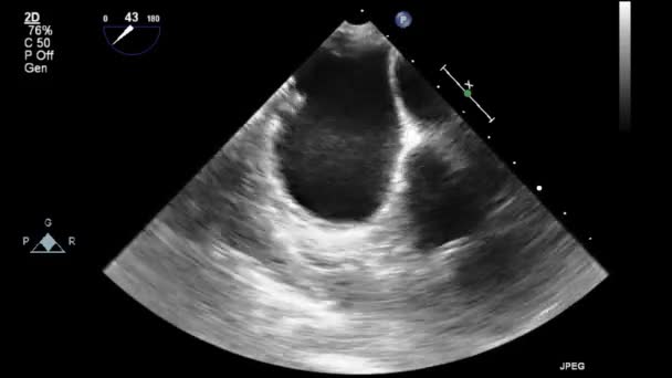 Ultraschall Transesophageale Untersuchung Des Herzens — Stockvideo