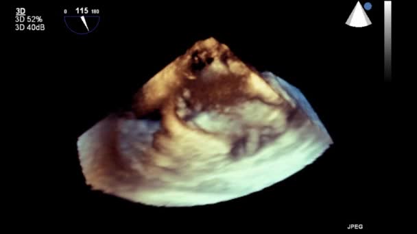 Ultrazvukové Transesofageální Vyšetření Srdce — Stock video