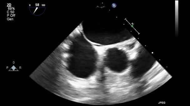 Echografie Transslokdarmonderzoek Van Het Hart — Stockvideo