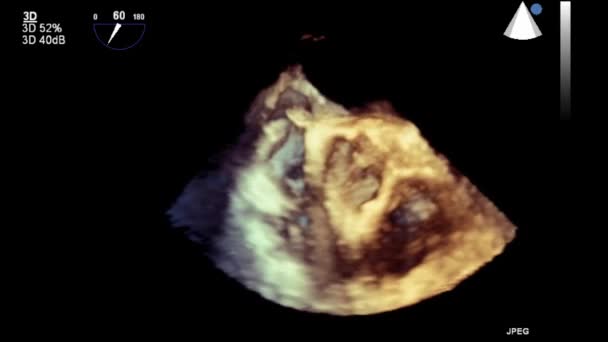 Ультразвуковое Трансофагеальное Исследование Сердца — стоковое видео