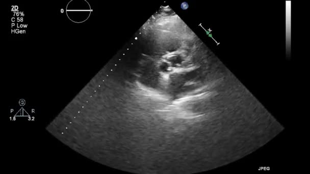 Exame Transesofágico Ultrassonográfico Coração — Vídeo de Stock