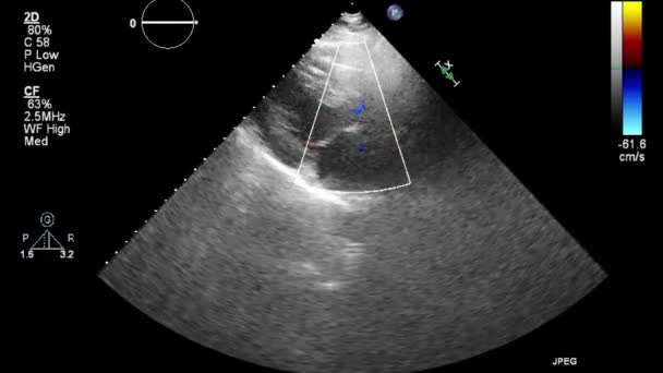 Ecografia Esame Transesofageo Del Cuore — Video Stock