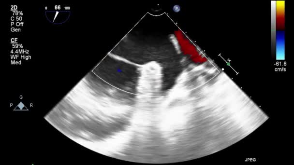 Ecografía Examen Transesofágico Del Corazón — Vídeos de Stock