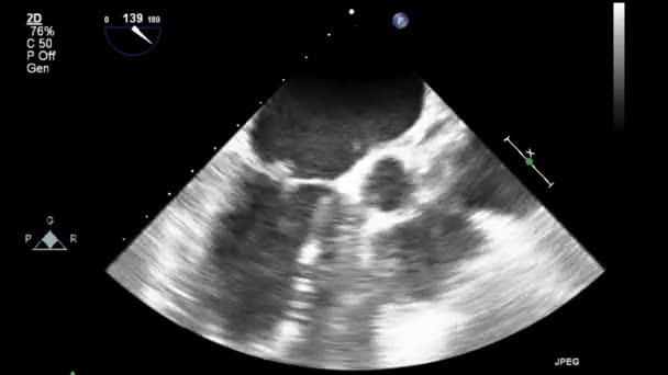 Echografie Transslokdarmonderzoek Van Het Hart — Stockvideo